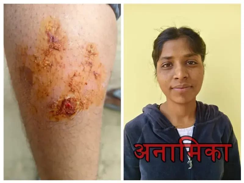 कटखन्ने बंदर ने एक माह में 20 महिलाओं और बच्च्यिों को काटा,लखनऊ के बौरुमऊ की घटना